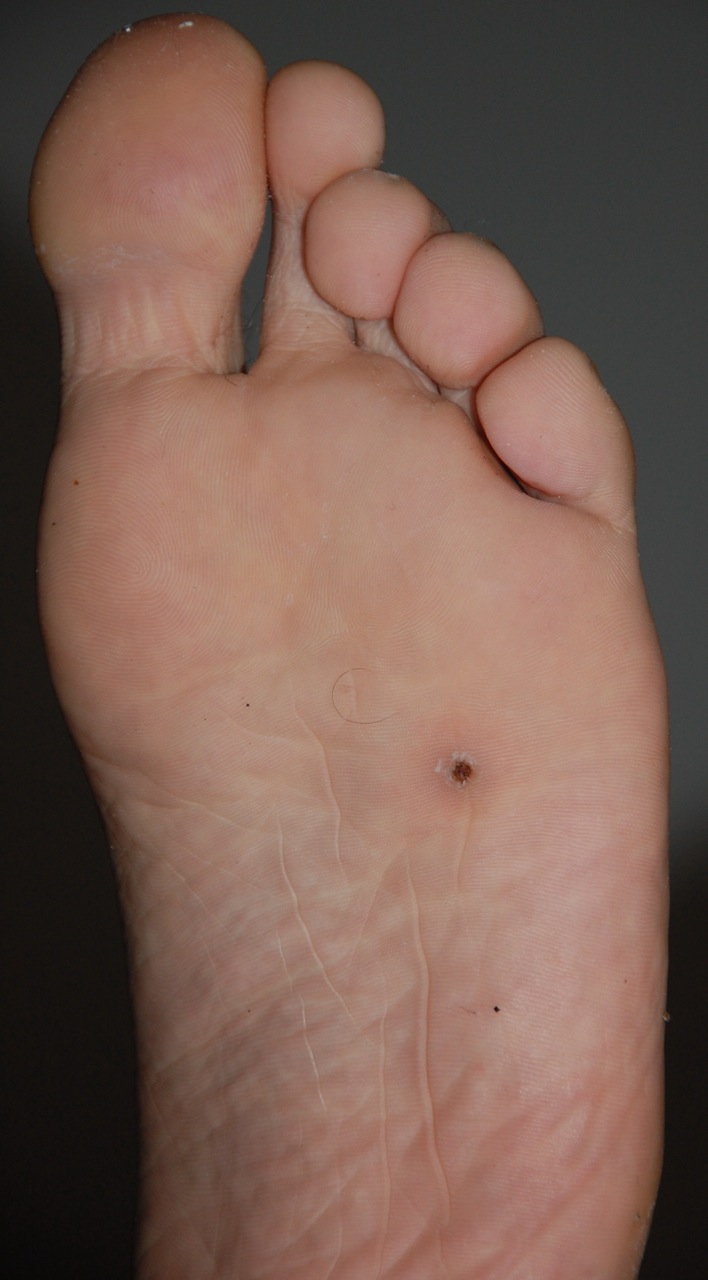 Edita Khainova Splinters on bottom of foot